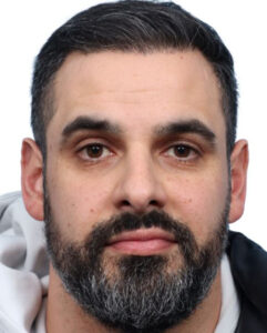 Fue Before and After | Dr. Jeffrey Wise