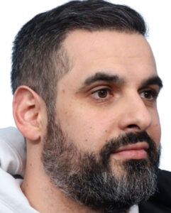 Fue Before and After | Dr. Jeffrey Wise