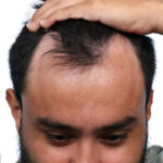 Fue Before and After | Dr. Jeffrey Wise