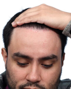 Fue Before and After | Dr. Jeffrey Wise