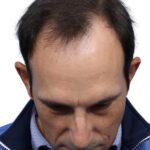 Fue Before and After | Dr. Jeffrey Wise