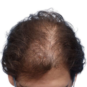 Fue Patient 261 Before