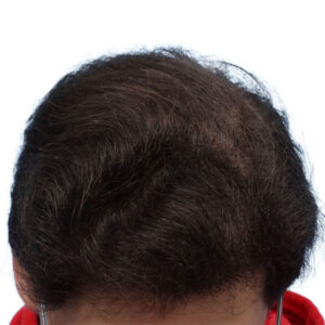 Fue Patient 261 After