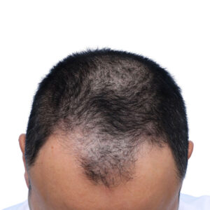 Fue Patient 262 Before