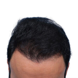 Fue Patient 262 After