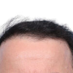 Fue Before and After | Dr. Jeffrey Wise