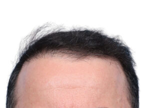 Fue Patient 264 Before