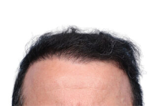 Fue Patient 264 After