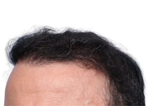 Fue Before and After | Dr. Jeffrey Wise