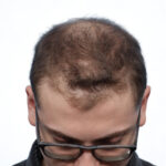 Fue Before and After | Dr. Jeffrey Wise