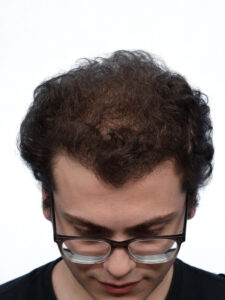 Fue Patient 265 After