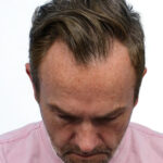 Fue Before and After | Dr. Jeffrey Wise
