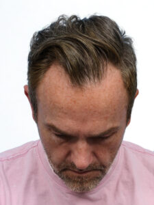Fue Patient 266 Before
