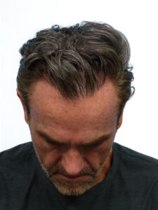 Fue Patient 266 After