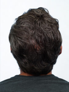 Fue Before and After | Dr. Jeffrey Wise