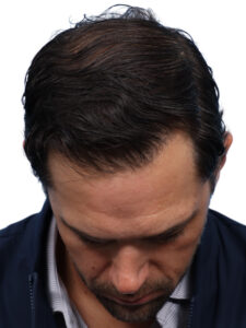 Fue Before and After | Dr. Jeffrey Wise