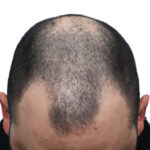Fue Before and After | Dr. Jeffrey Wise