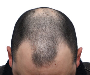 Fue Patient 269 Before