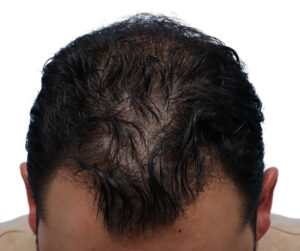 Fue Patient 269 After