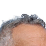 Fue Before and After | Dr. Jeffrey Wise