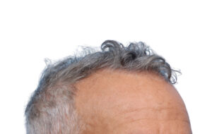 Fue Patient 270 Before