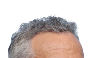 Fue Patient 270 After
