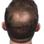 Fue Before and After | Dr. Jeffrey Wise