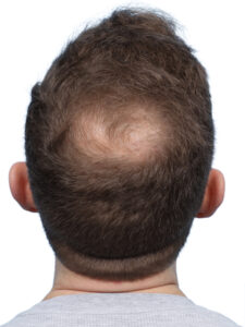 Fue Patient 271 Before