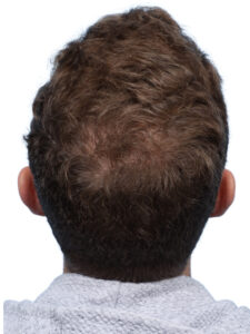 Fue Patient 271 After
