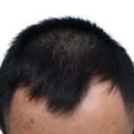 Fue Before and After | Dr. Jeffrey Wise