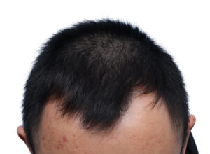 Fue Patient 272 Before