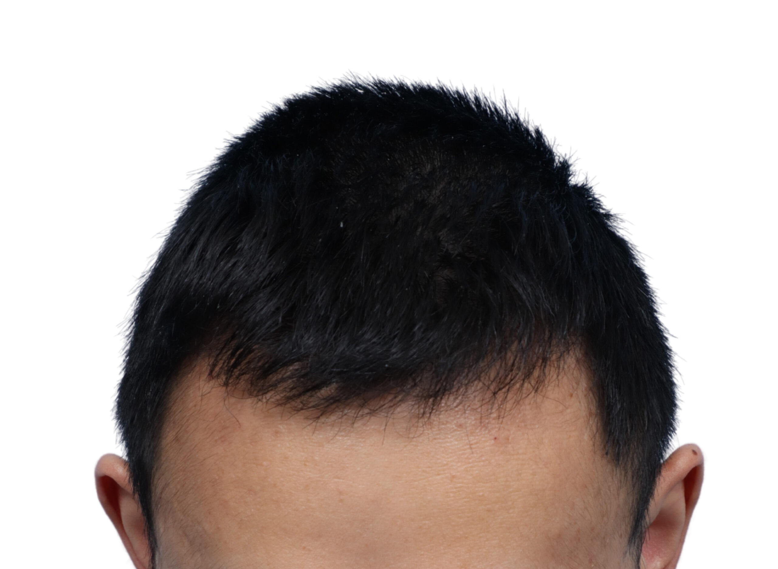 Fue Before and After | Dr. Jeffrey Wise
