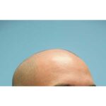 Fue Before and After | Dr. Jeffrey Wise