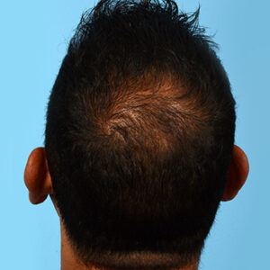 Fue Before and After | Dr. Jeffrey Wise