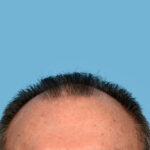 Fue Before and After | Dr. Jeffrey Wise