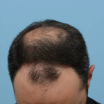 Fue Before and After | Dr. Jeffrey Wise