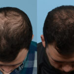 Fue Before and After | Dr. Jeffrey Wise