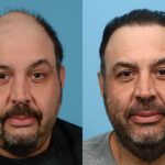 Fue Before and After | Dr. Jeffrey Wise