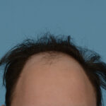 Fue Before and After | Dr. Jeffrey Wise