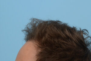 Fue Before and After | Dr. Jeffrey Wise