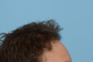 Fue Before and After | Dr. Jeffrey Wise