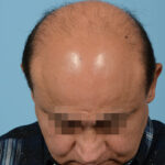 Fue Before and After | Dr. Jeffrey Wise