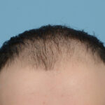 Fue Before and After | Dr. Jeffrey Wise