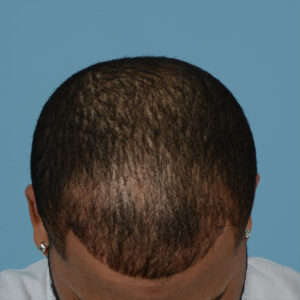 Fue Before and After | Dr. Jeffrey Wise