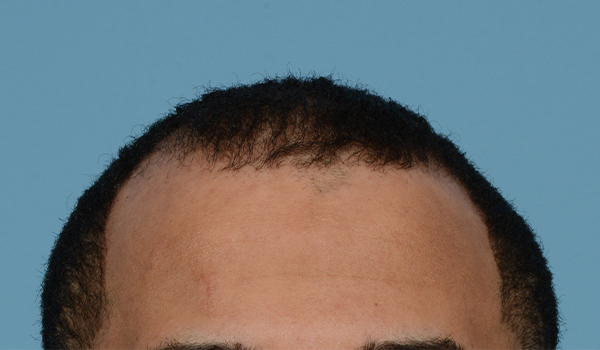 Fue Before and After | Dr. Jeffrey Wise