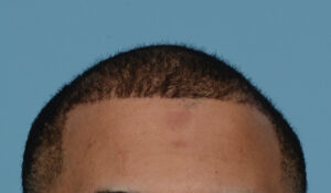 Fue Before and After | Dr. Jeffrey Wise