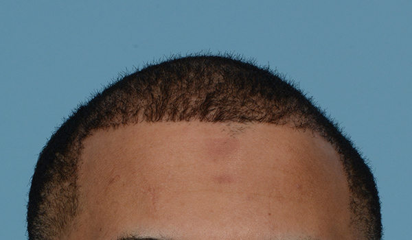 Fue Before and After | Dr. Jeffrey Wise