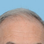 Fue Before and After | Dr. Jeffrey Wise
