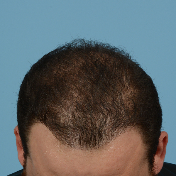 Fue Before and After | Dr. Jeffrey Wise