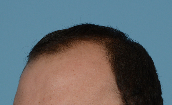 Fue Before and After | Dr. Jeffrey Wise